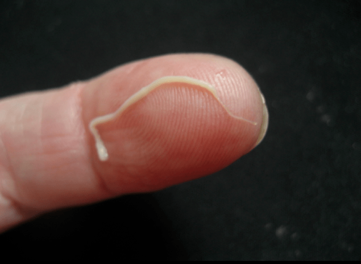 Roundworm parasite from the human body